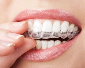 invisalign5-300x241